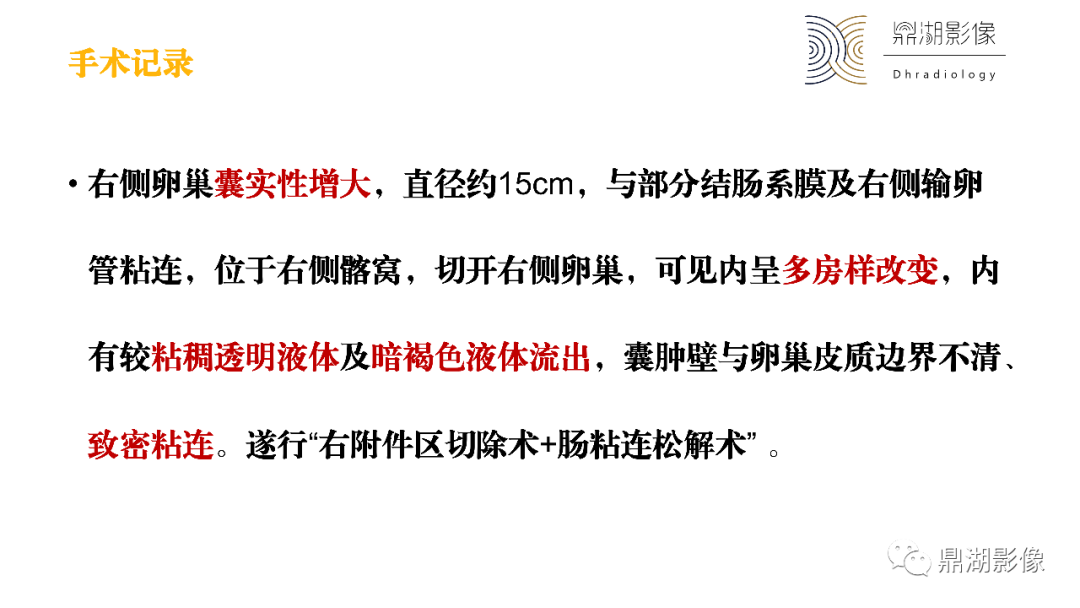 影像PPT - 【PPT】卵巢囊腺瘤/癌诊断及鉴别-11