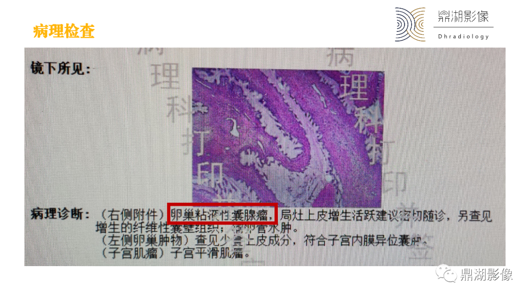 影像PPT - 【PPT】卵巢囊腺瘤/癌诊断及鉴别-12