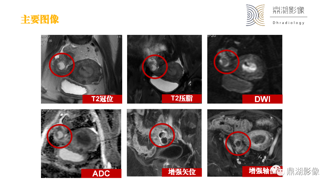 影像PPT - 【PPT】卵巢囊腺瘤/癌诊断及鉴别-14