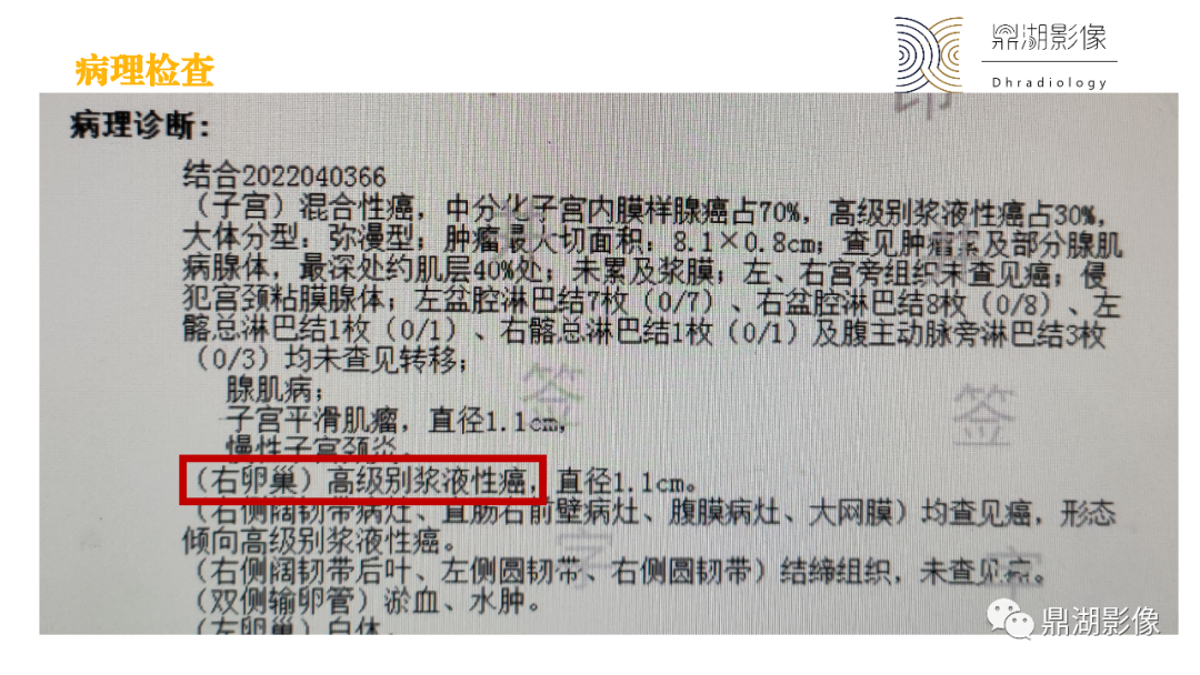 影像PPT - 【PPT】卵巢囊腺瘤/癌诊断及鉴别-16