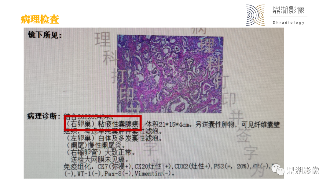 影像PPT - 【PPT】卵巢囊腺瘤/癌诊断及鉴别-20