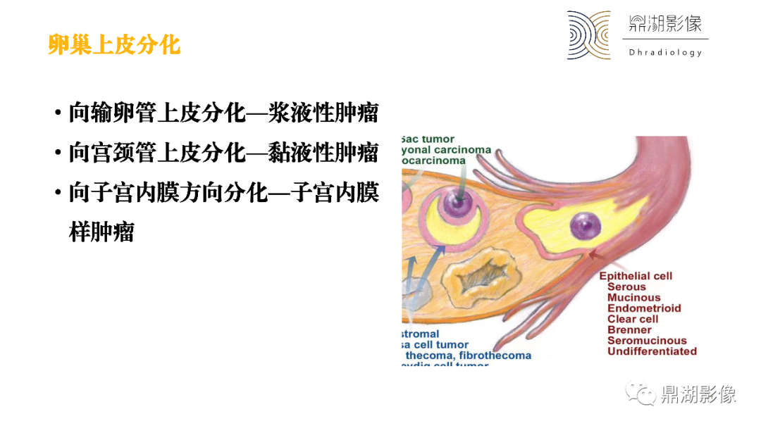 影像PPT - 【PPT】卵巢囊腺瘤/癌诊断及鉴别-24