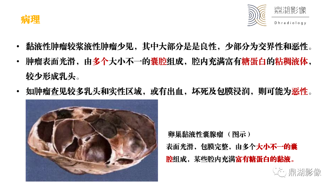 影像PPT - 【PPT】卵巢囊腺瘤/癌诊断及鉴别-28