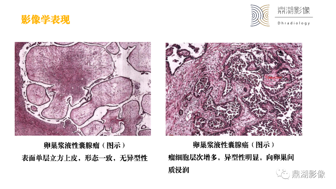影像PPT - 【PPT】卵巢囊腺瘤/癌诊断及鉴别-27