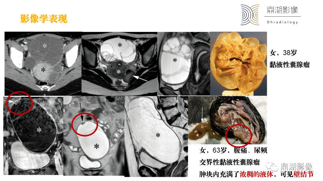 影像PPT - 【PPT】卵巢囊腺瘤/癌诊断及鉴别-39