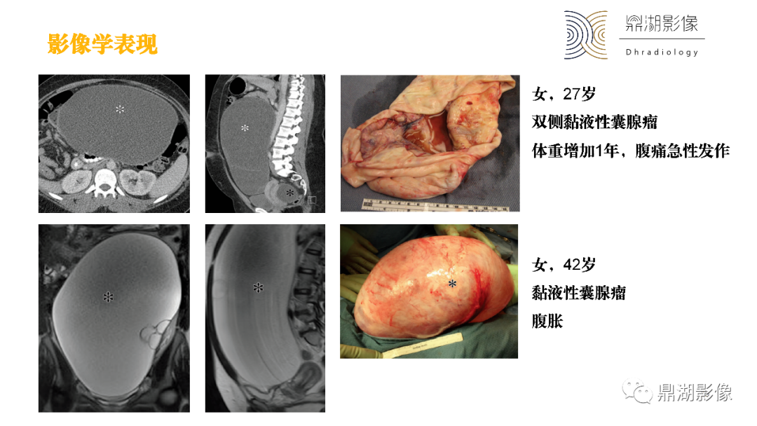 影像PPT - 【PPT】卵巢囊腺瘤/癌诊断及鉴别-38