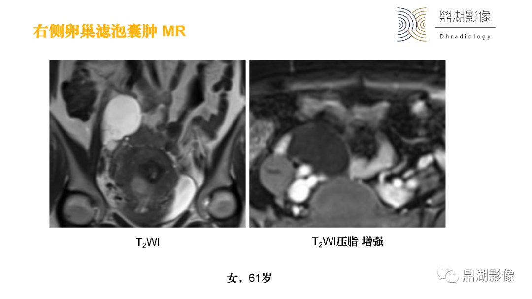 影像PPT - 【PPT】卵巢囊腺瘤/癌诊断及鉴别-44
