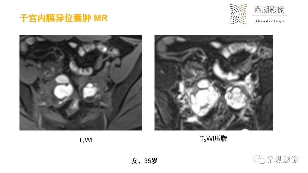 影像PPT - 【PPT】卵巢囊腺瘤/癌诊断及鉴别-46