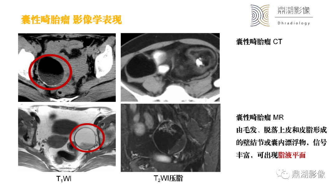 影像PPT - 【PPT】卵巢囊腺瘤/癌诊断及鉴别-48