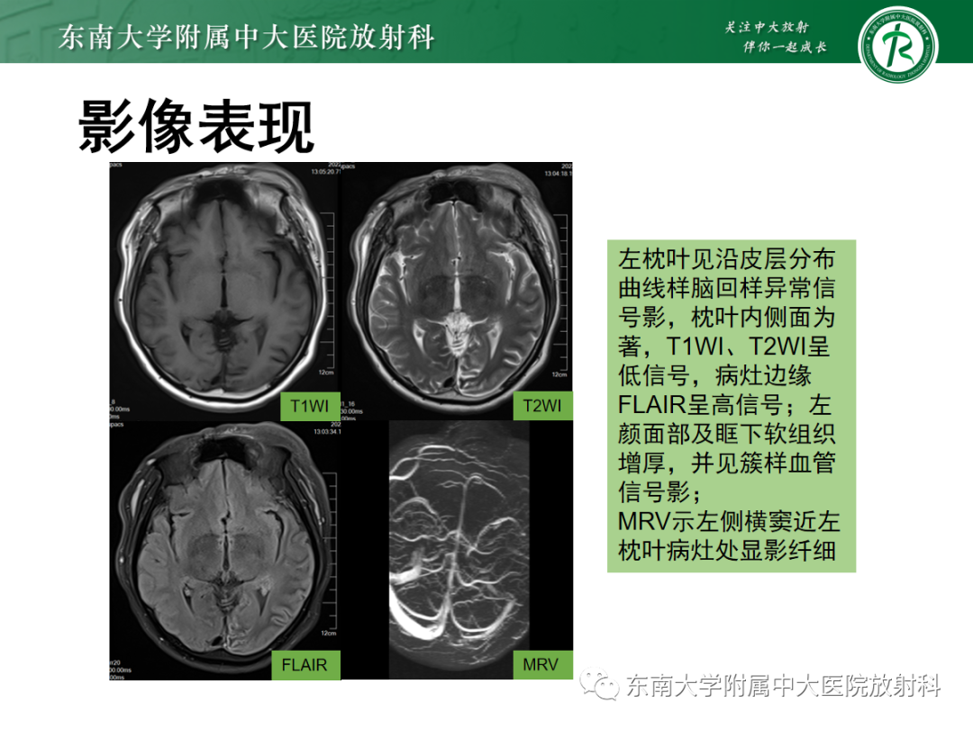 影像PPT - 【PPT】Sturge-Weber综合征-4 影像PPT - 【PPT】Sturge-Weber综合征-4