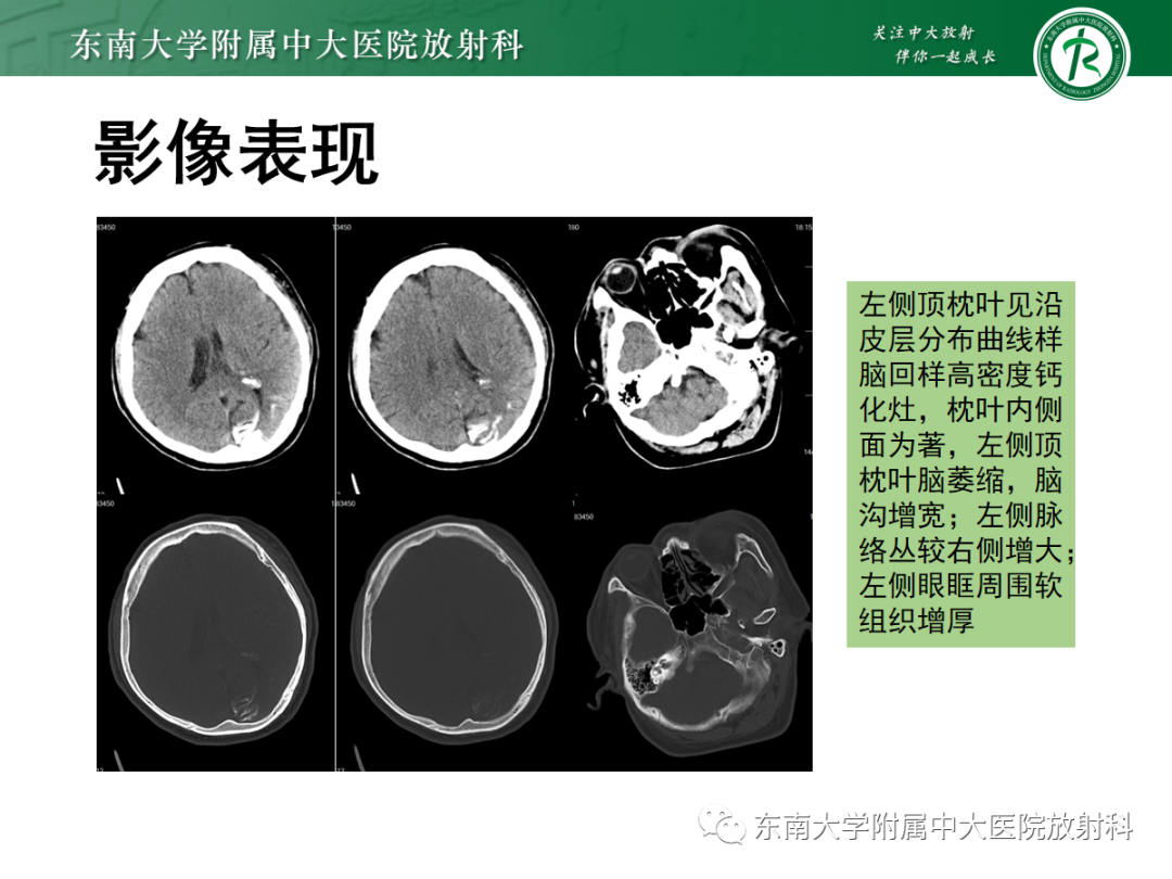 影像PPT - 【PPT】Sturge-Weber综合征-3 影像PPT - 【PPT】Sturge-Weber综合征-3
