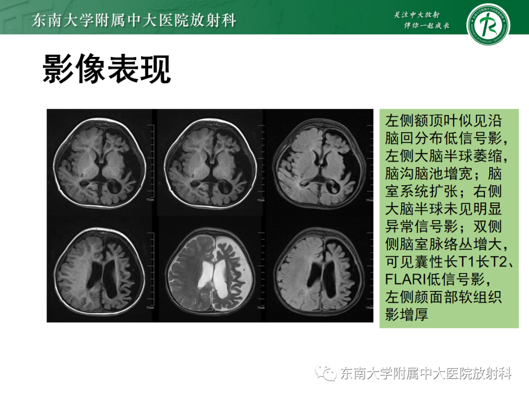 影像PPT - 【PPT】Sturge-Weber综合征-6 影像PPT - 【PPT】Sturge-Weber综合征-6