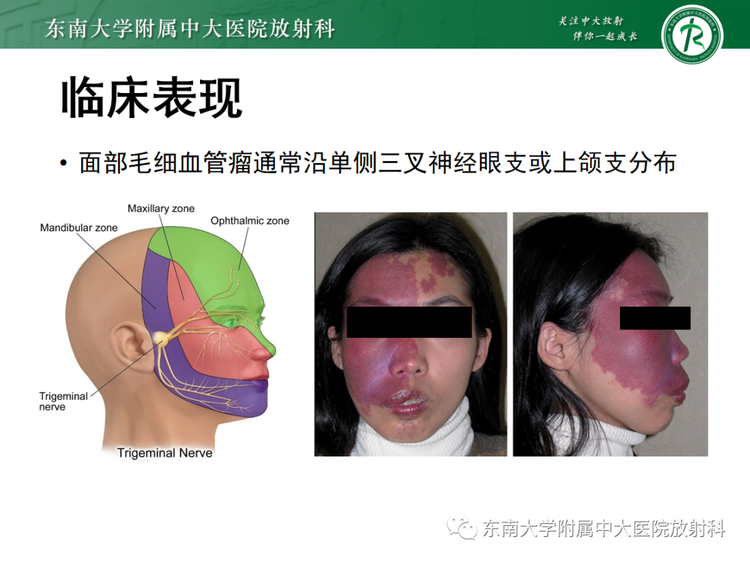 影像PPT - 【PPT】Sturge-Weber综合征-13 影像PPT - 【PPT】Sturge-Weber综合征-13