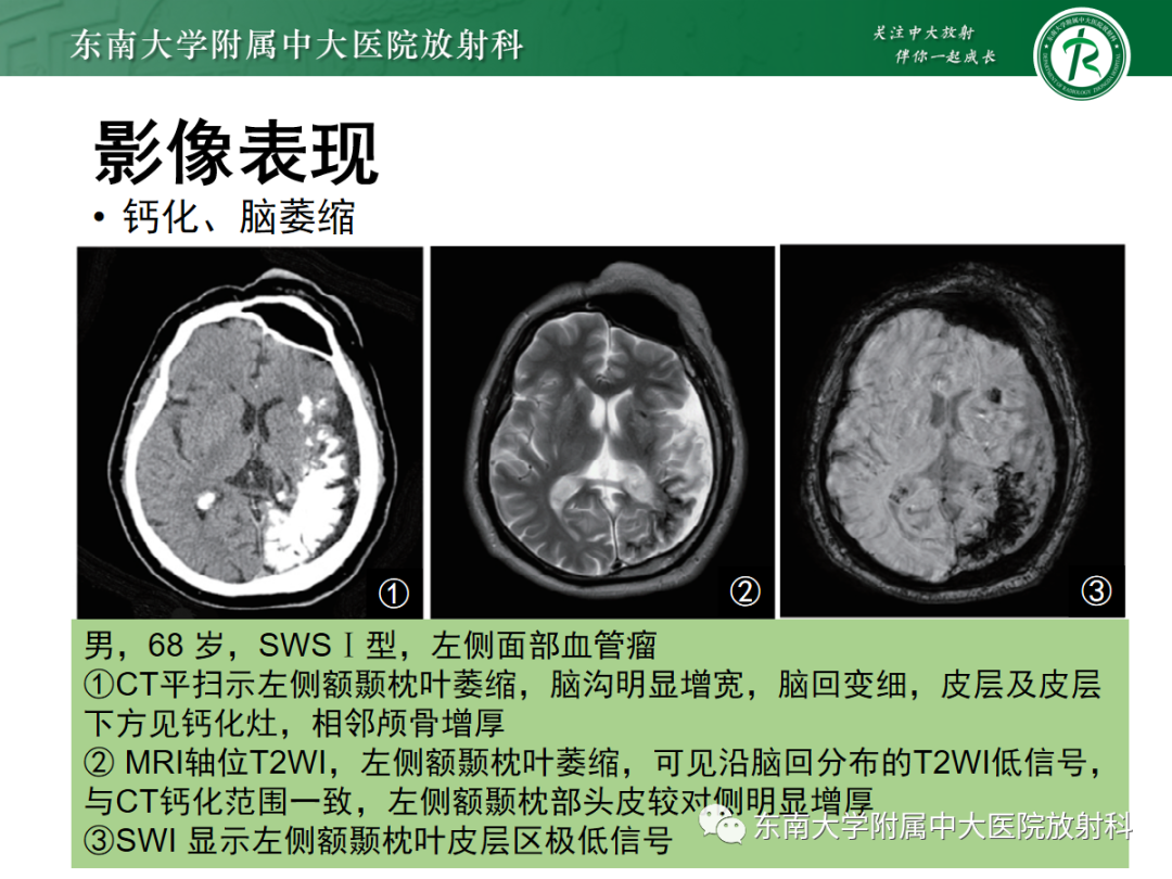 影像PPT - 【PPT】Sturge-Weber综合征-21 影像PPT - 【PPT】Sturge-Weber综合征-21