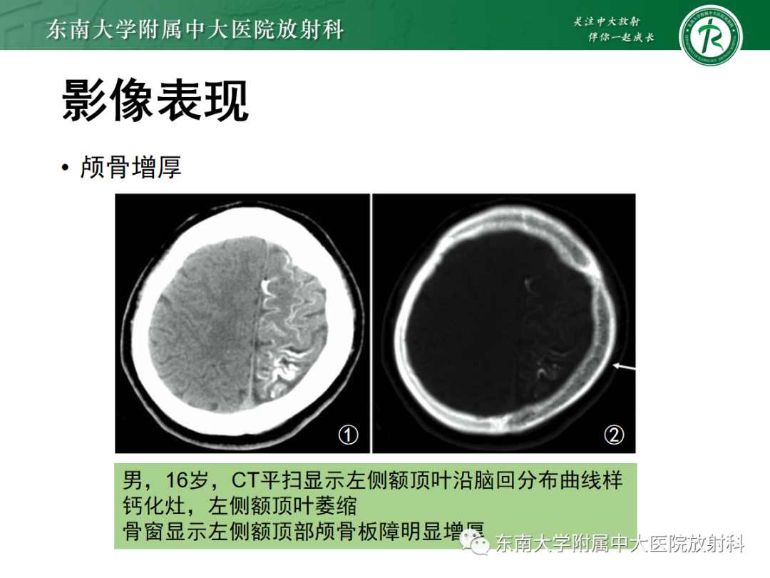 影像PPT - 【PPT】Sturge-Weber综合征-22 影像PPT - 【PPT】Sturge-Weber综合征-22