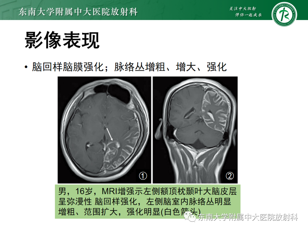 影像PPT - 【PPT】Sturge-Weber综合征-23 影像PPT - 【PPT】Sturge-Weber综合征-23