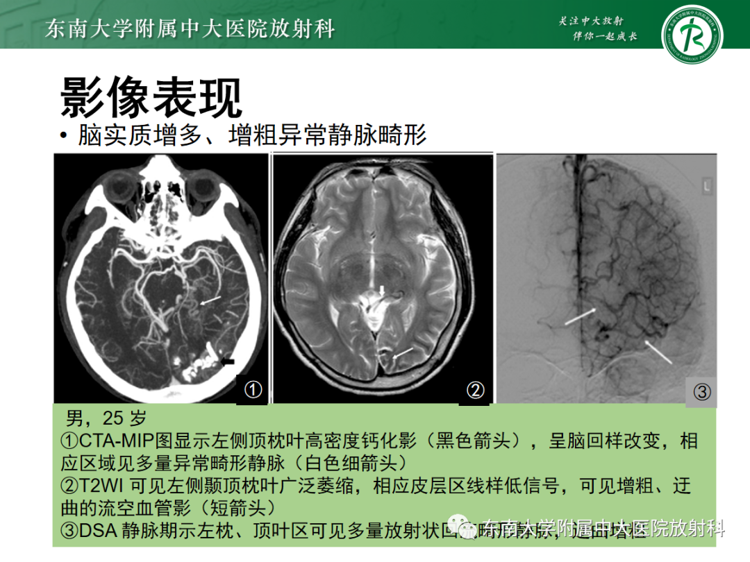 影像PPT - 【PPT】Sturge-Weber综合征-24 影像PPT - 【PPT】Sturge-Weber综合征-24