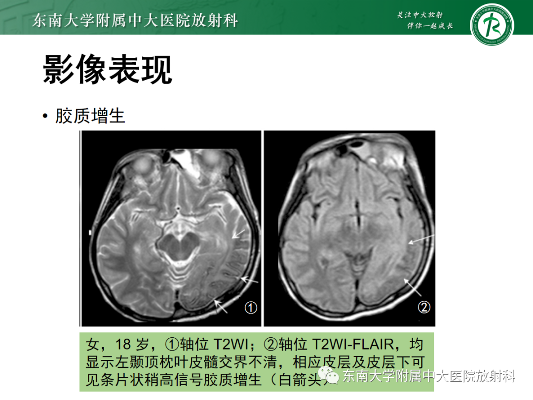 影像PPT - 【PPT】Sturge-Weber综合征-25 影像PPT - 【PPT】Sturge-Weber综合征-25