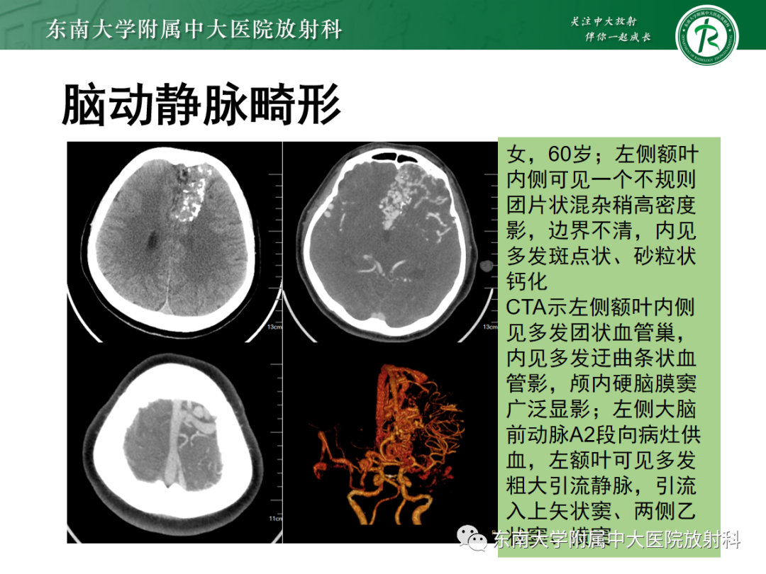 影像PPT - 【PPT】Sturge-Weber综合征-27 影像PPT - 【PPT】Sturge-Weber综合征-27