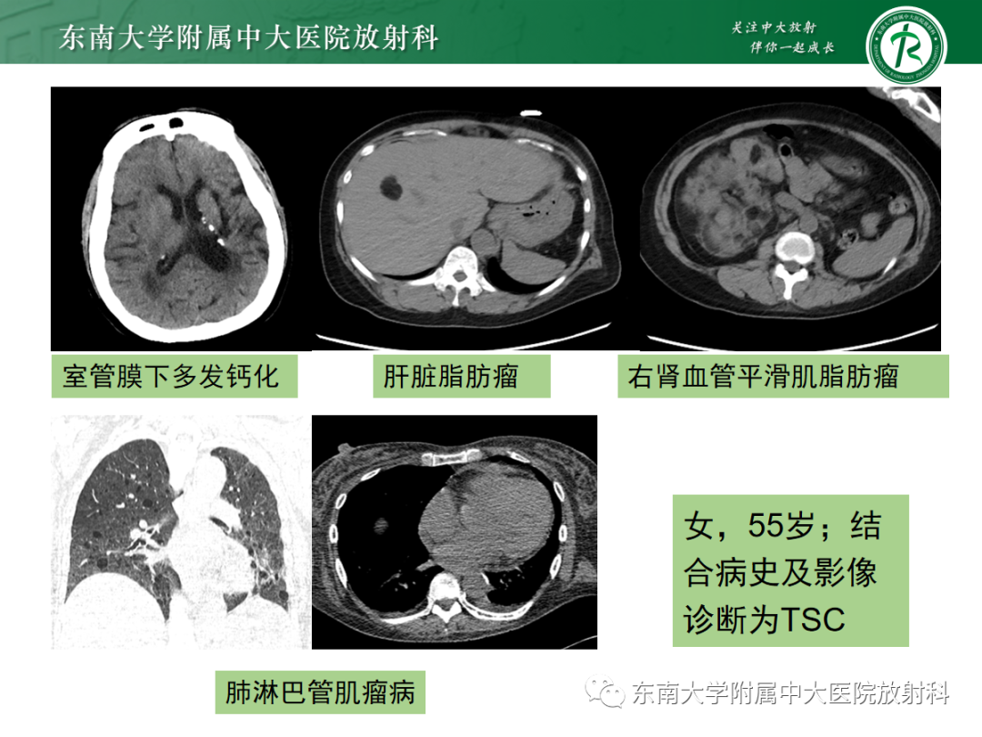 影像PPT - 【PPT】Sturge-Weber综合征-29 影像PPT - 【PPT】Sturge-Weber综合征-29