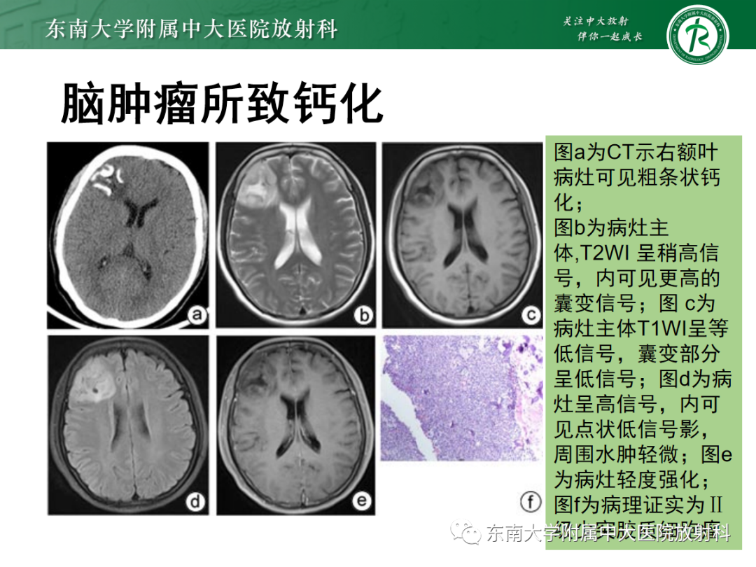 影像PPT - 【PPT】Sturge-Weber综合征-31 影像PPT - 【PPT】Sturge-Weber综合征-31