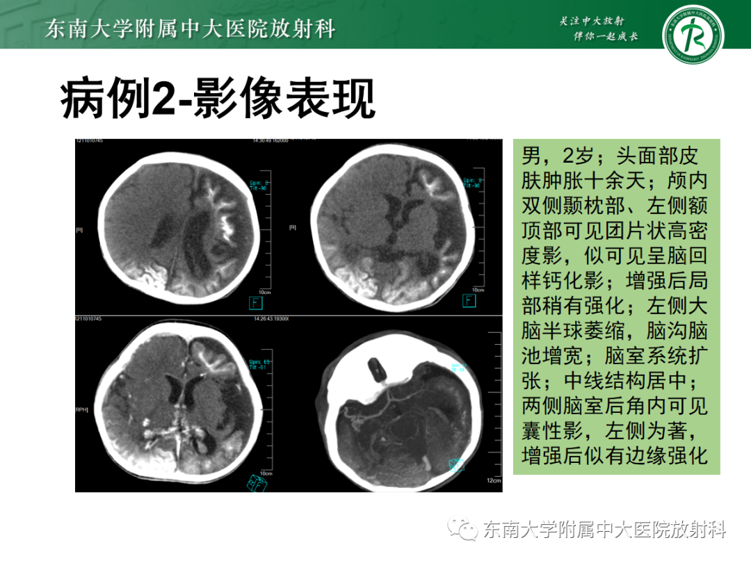 影像PPT - 【PPT】Sturge-Weber综合征-3 影像PPT - 【PPT】Sturge-Weber综合征-3