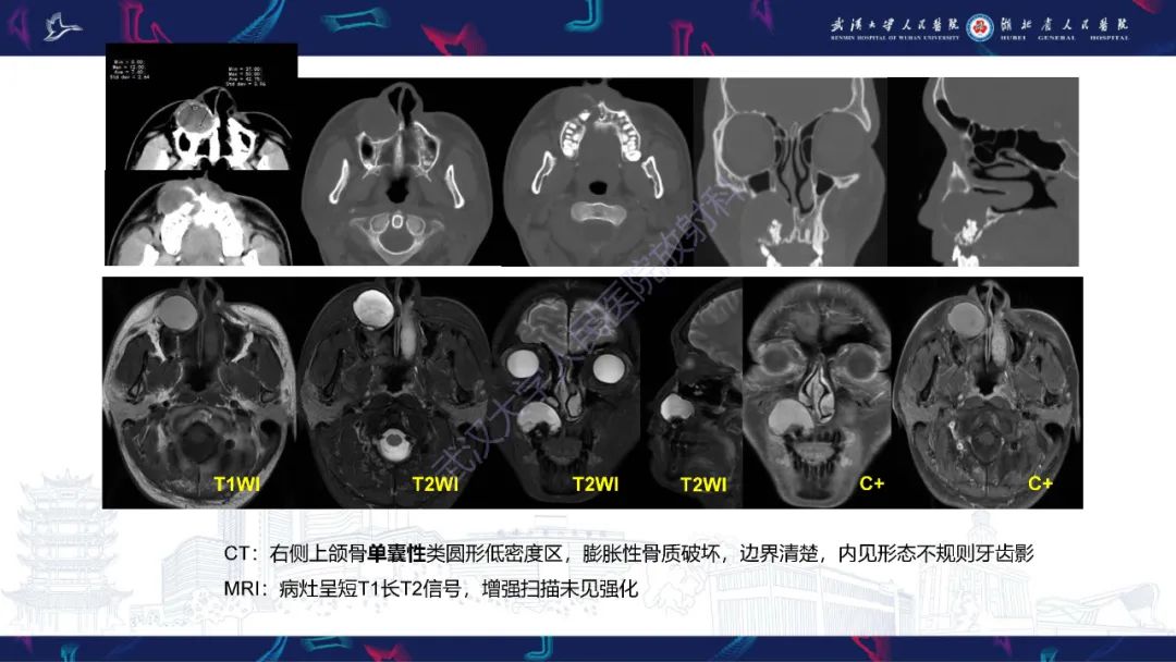 影像PPT - 【PPT】成釉细胞瘤影像诊断-3
