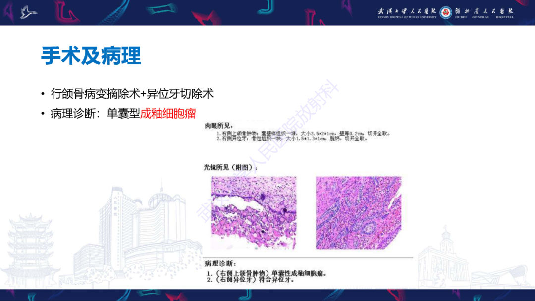 影像PPT - 【PPT】成釉细胞瘤影像诊断-4