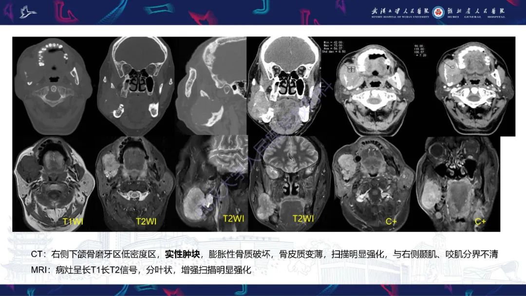 影像PPT - 【PPT】成釉细胞瘤影像诊断-6