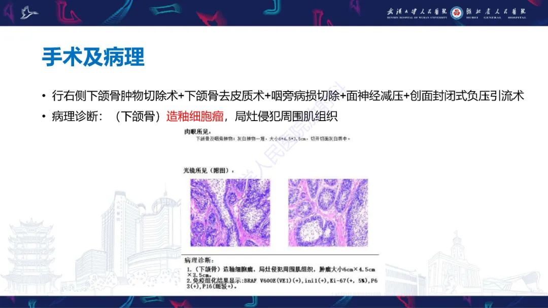 影像PPT - 【PPT】成釉细胞瘤影像诊断-7