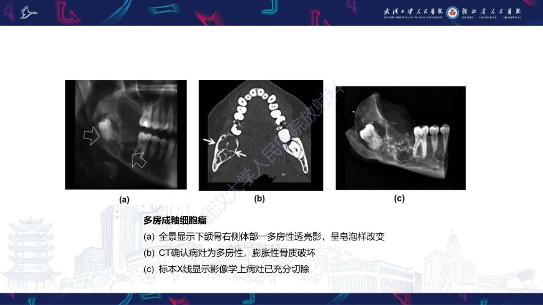 影像PPT - 【PPT】成釉细胞瘤影像诊断-19