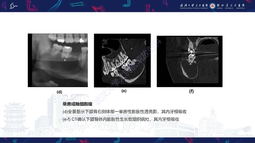 影像PPT - 【PPT】成釉细胞瘤影像诊断-20