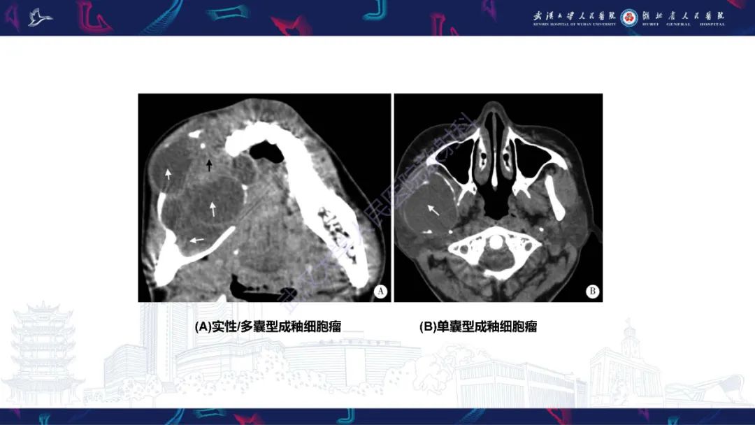 影像PPT - 【PPT】成釉细胞瘤影像诊断-21