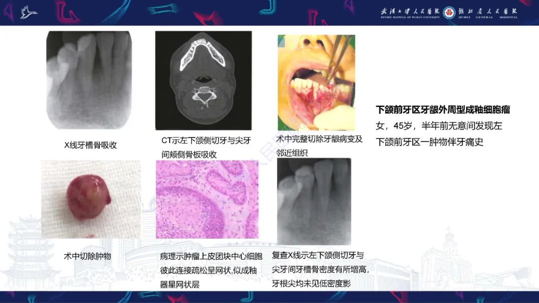 影像PPT - 【PPT】成釉细胞瘤影像诊断-23