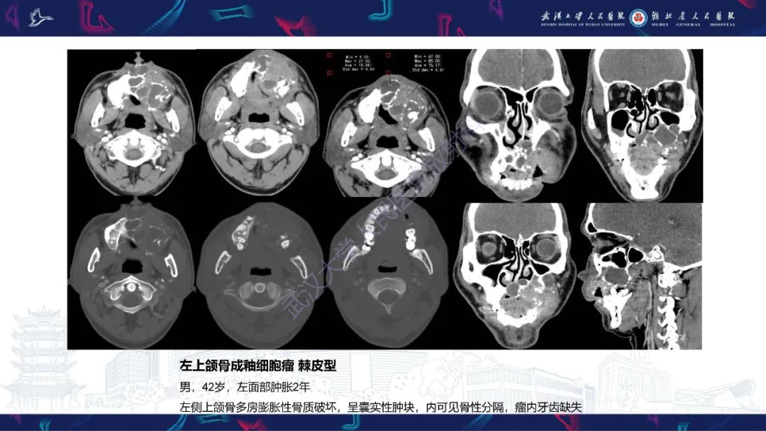 影像PPT - 【PPT】成釉细胞瘤影像诊断-22