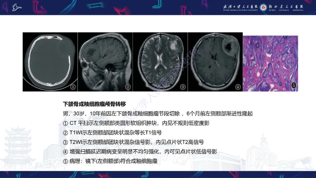 影像PPT - 【PPT】成釉细胞瘤影像诊断-24