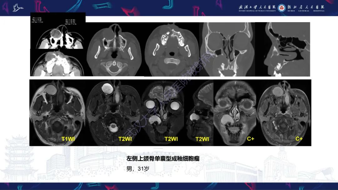 影像PPT - 【PPT】成釉细胞瘤影像诊断-25