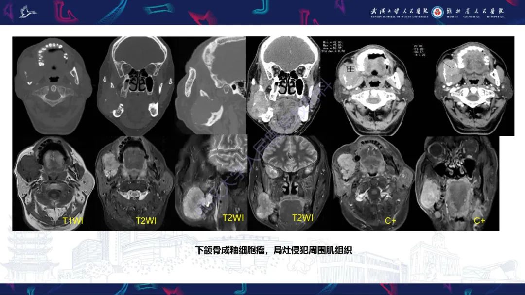 影像PPT - 【PPT】成釉细胞瘤影像诊断-26