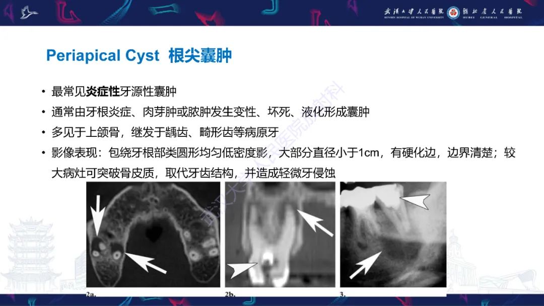 影像PPT - 【PPT】成釉细胞瘤影像诊断-29