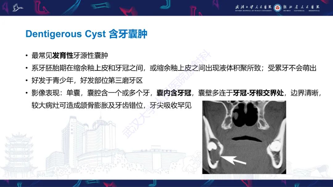 影像PPT - 【PPT】成釉细胞瘤影像诊断-30