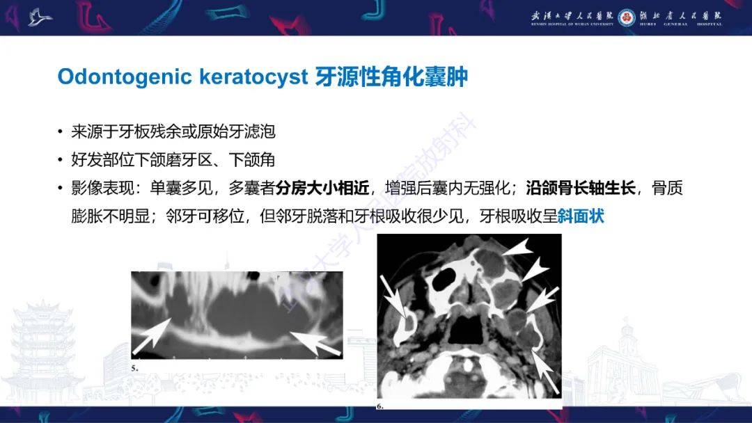 影像PPT - 【PPT】成釉细胞瘤影像诊断-31