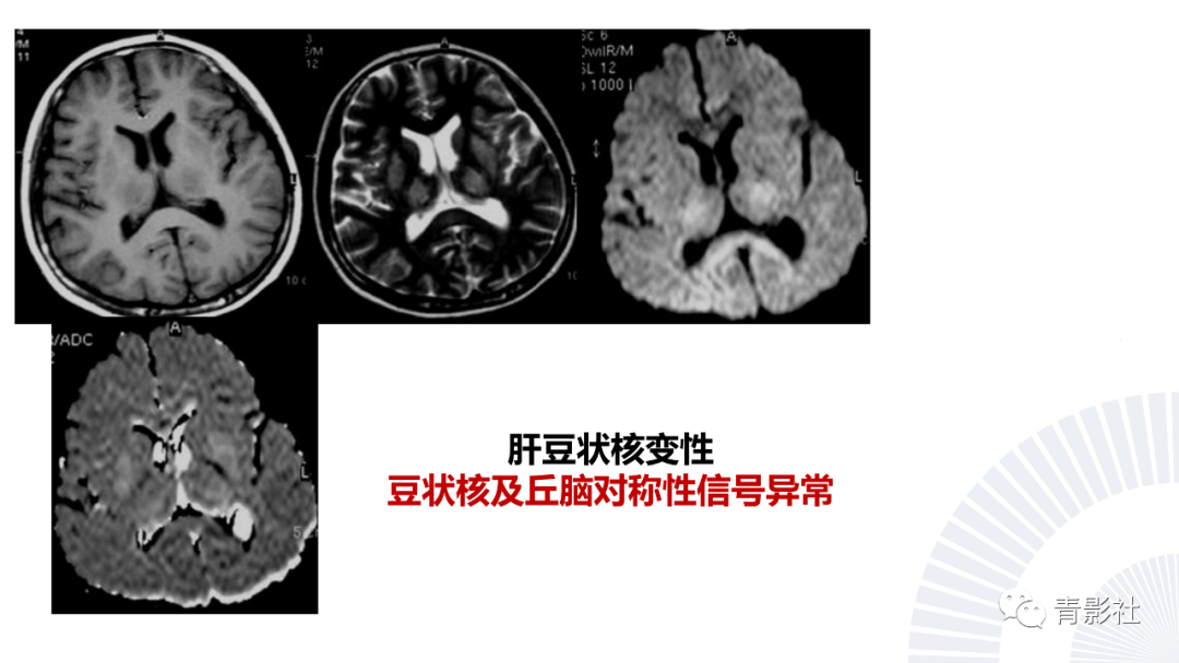 影像PPT - 【PPT】丘脑解剖及常见病变的影像学诊断-11