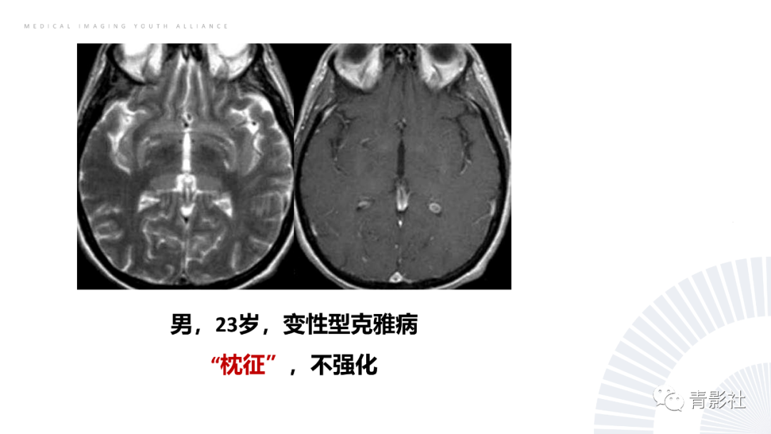 影像PPT - 【PPT】丘脑解剖及常见病变的影像学诊断-14