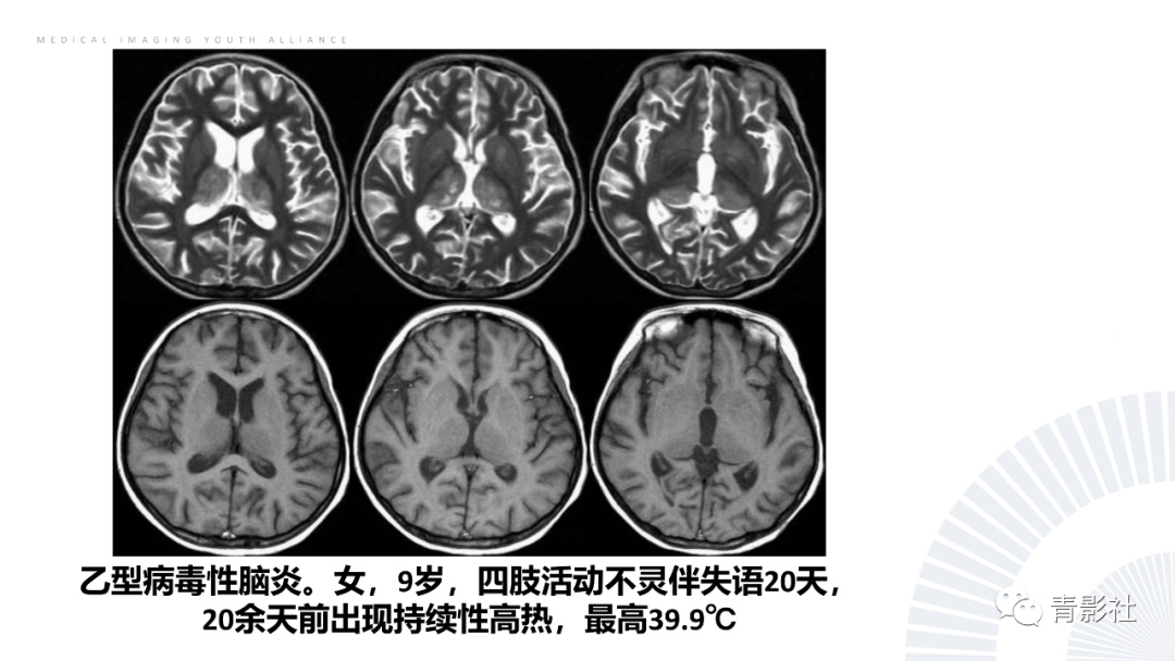 影像PPT - 【PPT】丘脑解剖及常见病变的影像学诊断-17