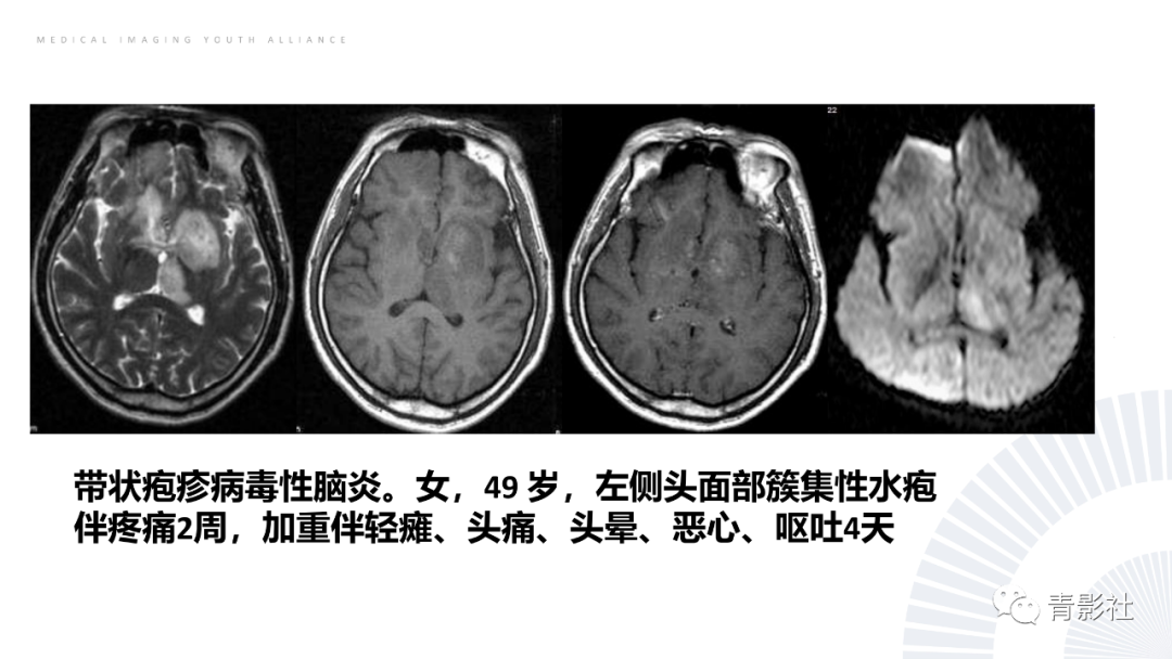影像PPT - 【PPT】丘脑解剖及常见病变的影像学诊断-18