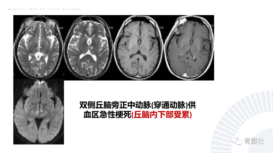 影像PPT - 【PPT】丘脑解剖及常见病变的影像学诊断-20