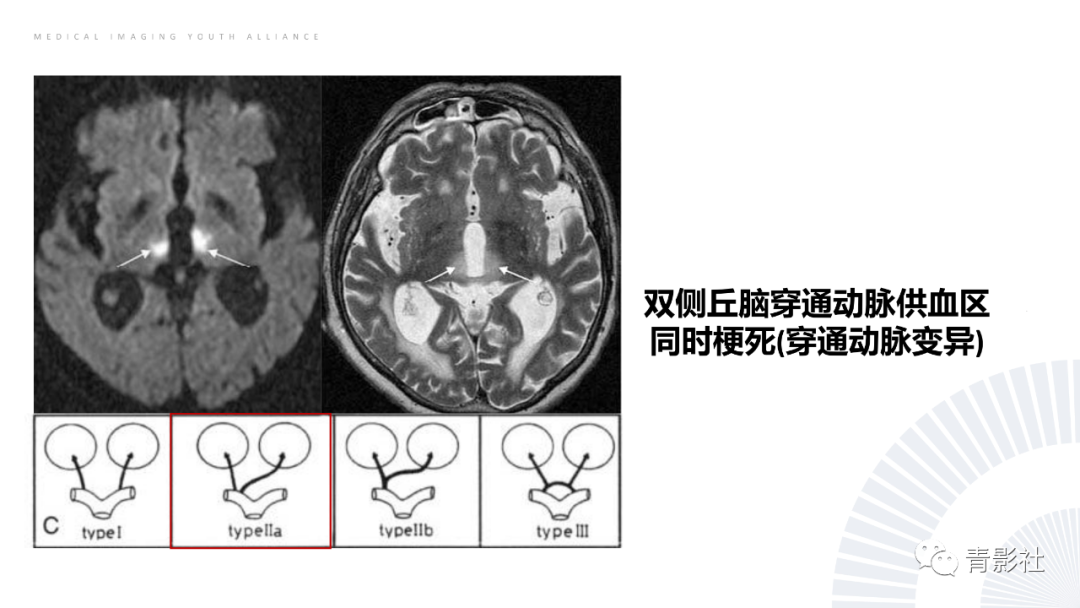 影像PPT - 【PPT】丘脑解剖及常见病变的影像学诊断-21