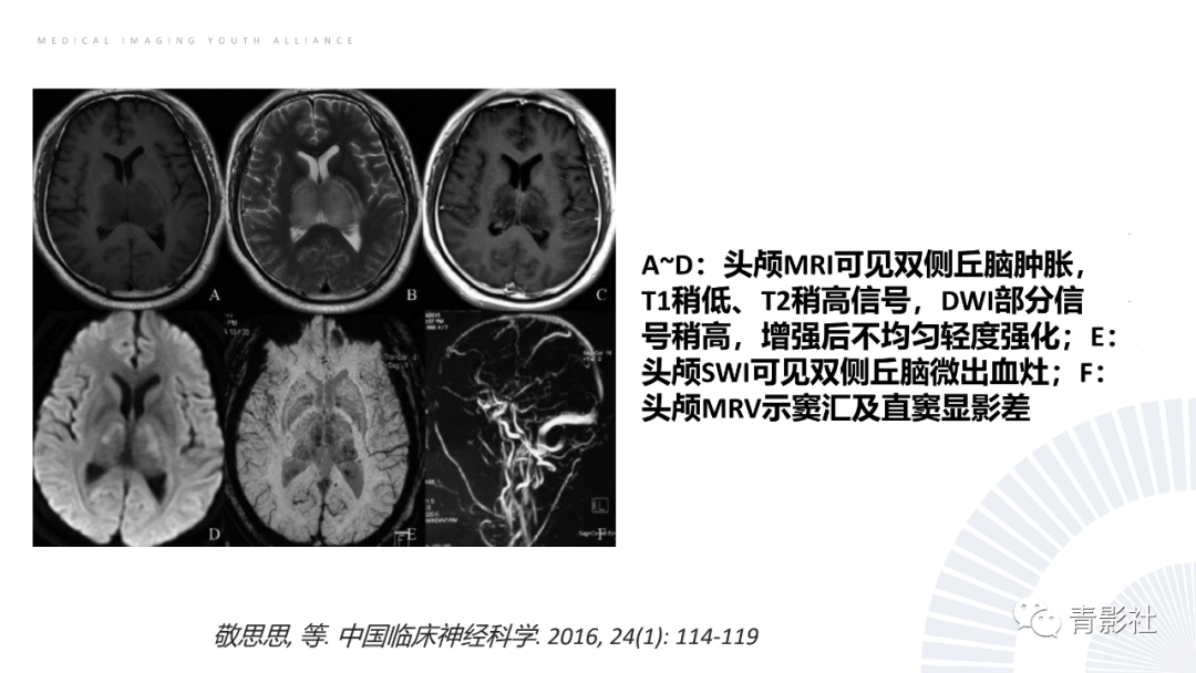 影像PPT - 【PPT】丘脑解剖及常见病变的影像学诊断-24
