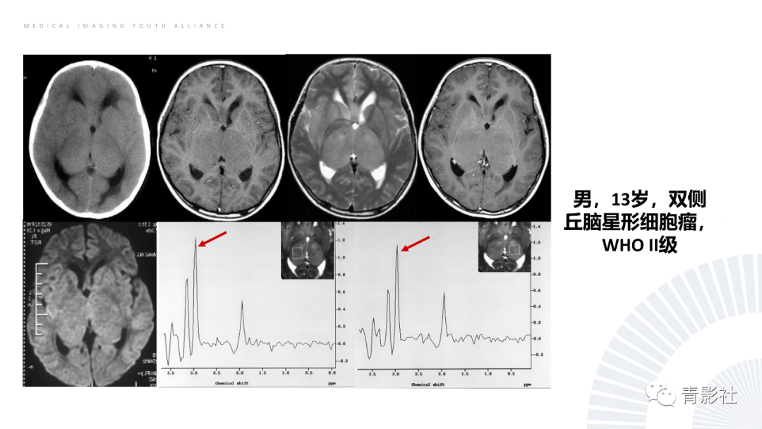 影像PPT - 【PPT】丘脑解剖及常见病变的影像学诊断-26