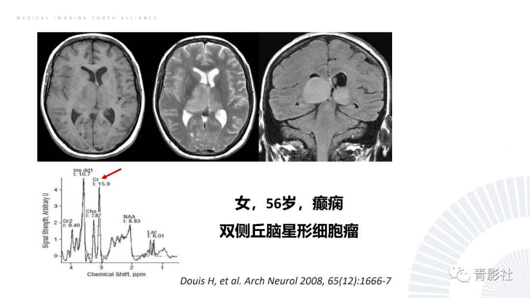 影像PPT - 【PPT】丘脑解剖及常见病变的影像学诊断-27